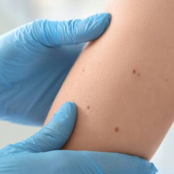 Cele Mai Frecvente Simptome Ale Cancerului Pe Care Ar Trebui Să Le Verifici. De La Balonare și Oboseală La Pierderea Vocii
